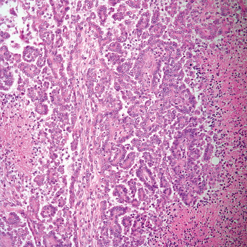 Tumors Of The Pleura | Thoracic Key