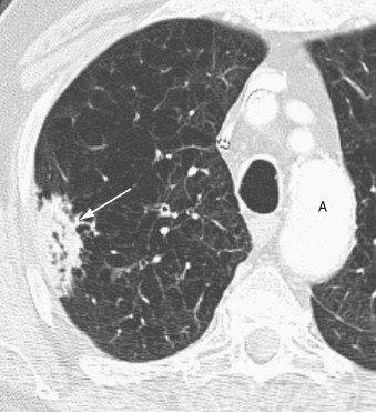 Imaging Tumors Of The Lung And Pleura | Thoracic Key