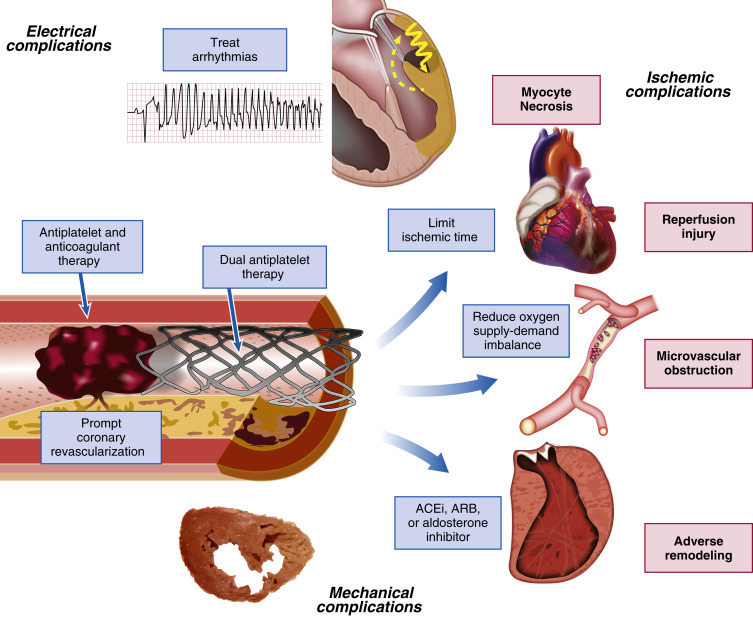 Management Principles In Myocardial Infarction | Thoracic Key