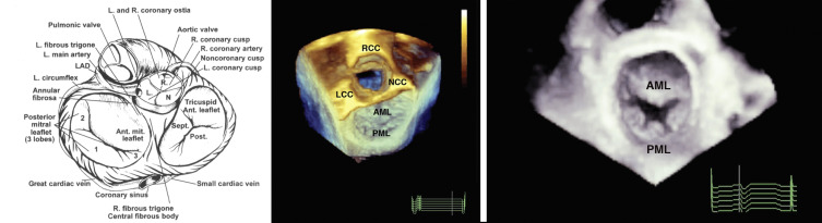 Mitral Valve Disease | Thoracic Key