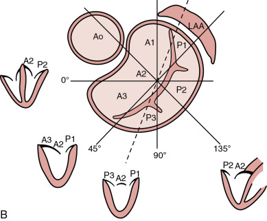 Mitral Valve Disease | Thoracic Key