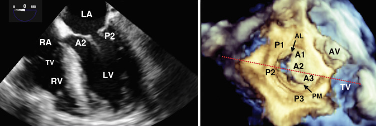 Mitral Valve Disease | Thoracic Key