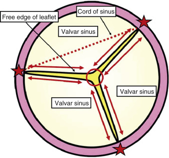 Pulmonary Stenosis | Thoracic Key