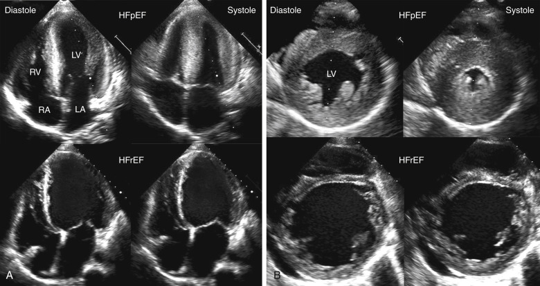 Cardiac Imaging In Heart Failure | Thoracic Key