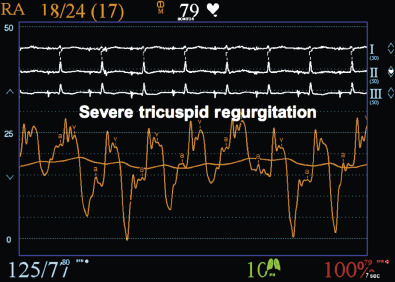 Hemodynamics In Heart Failure | Thoracic Key