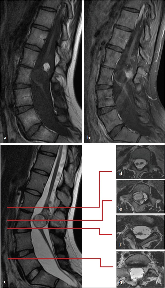 Intramedullary Spinal Cord Tumors | Thoracic Key