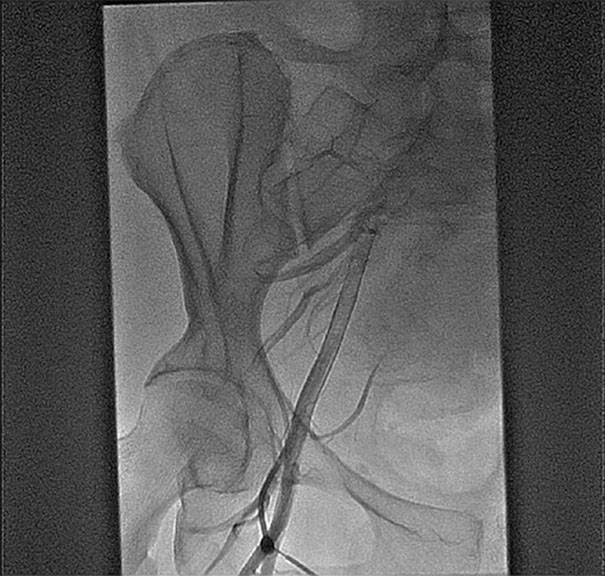 Cardiac Catheterization | Thoracic Key