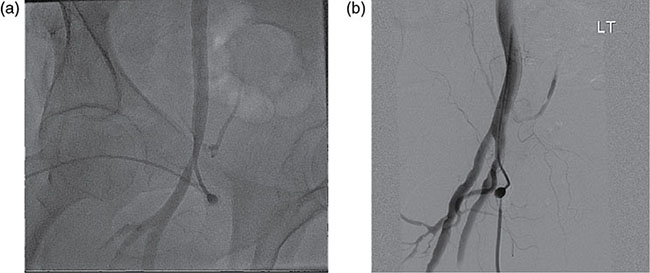 Cardiac Catheterization | Thoracic Key