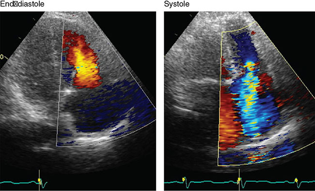 Valvular Heart Disease | Thoracic Key