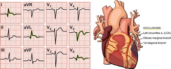 Chapter 3 – Anterior Wall Myocardial Infarction | Thoracic Key