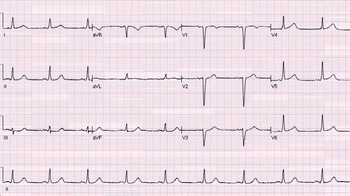 Chapter 3 – Anterior Wall Myocardial Infarction | Thoracic Key