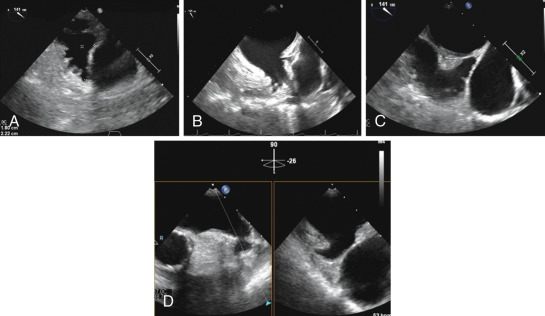 Left Atrial Appendage Occlusion | Thoracic Key