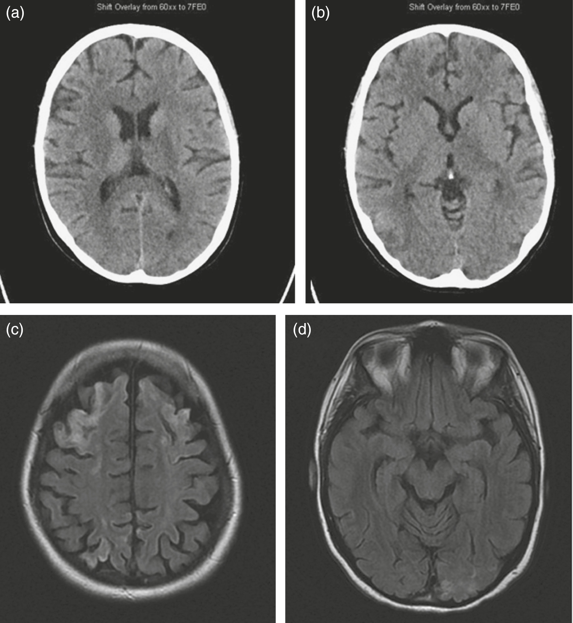 46 – Neurological Aspects of Cardiac Surgery | Thoracic Key