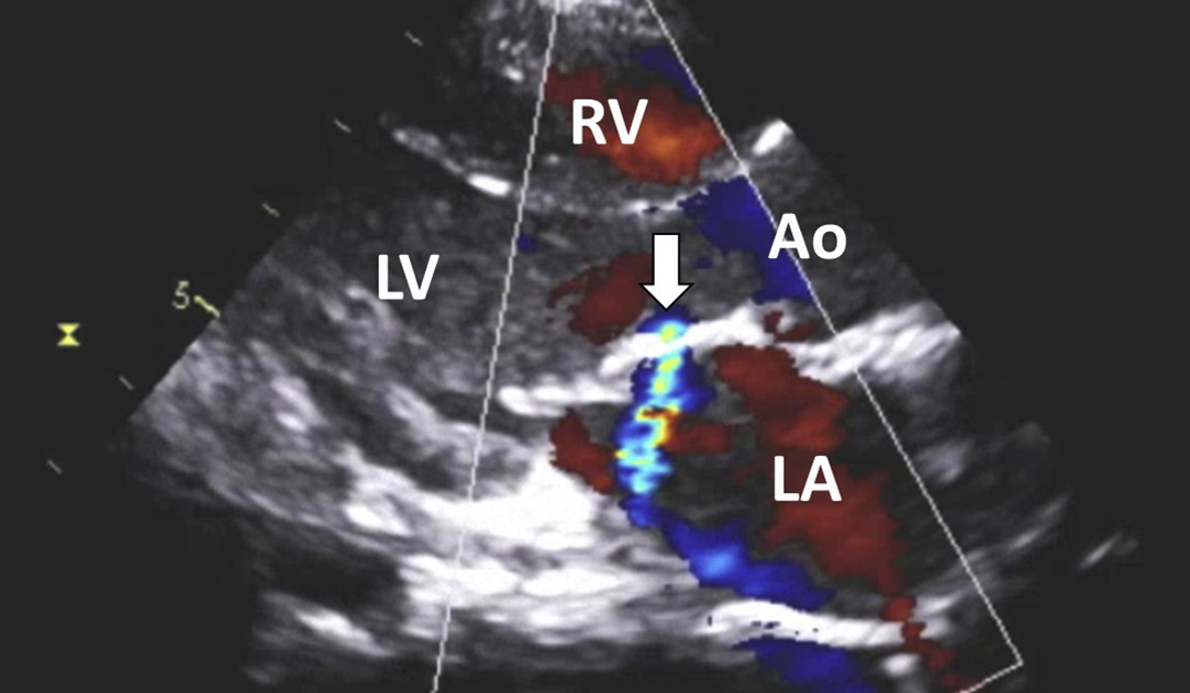 Diseases Of The Mitral Valve | Thoracic Key