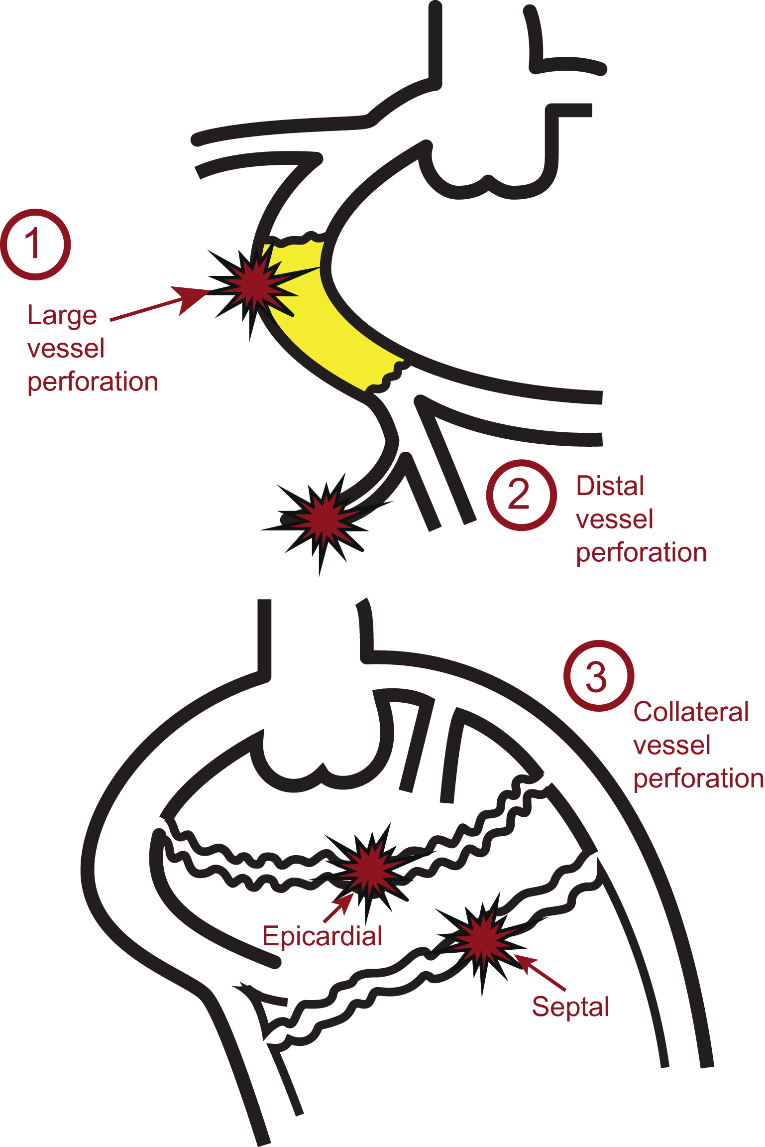 Perforation | Thoracic Key