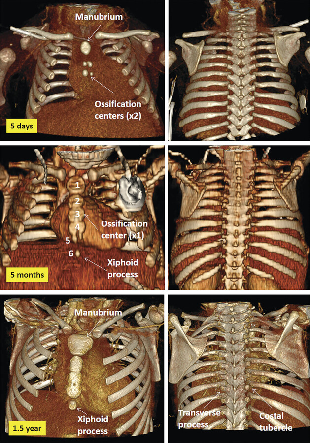 Xiphoid Process Protruding