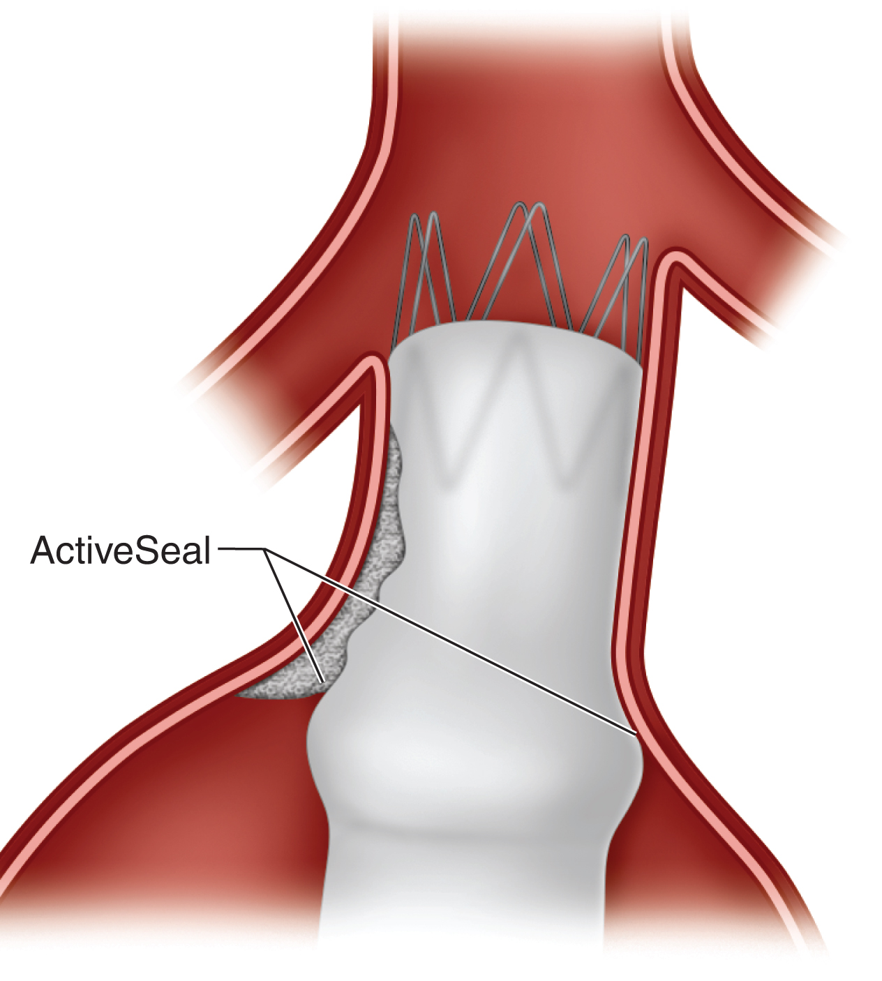 Endologix AFX | Thoracic Key