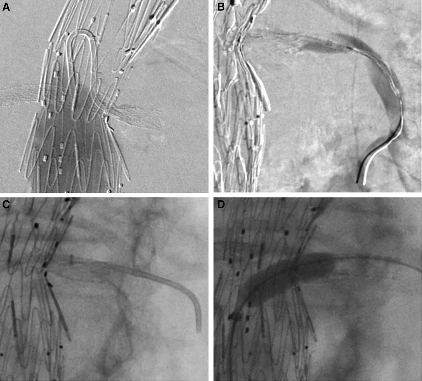 Complications In Endovascular Thoracoabdominal Aortic Aneurysm Repair ...