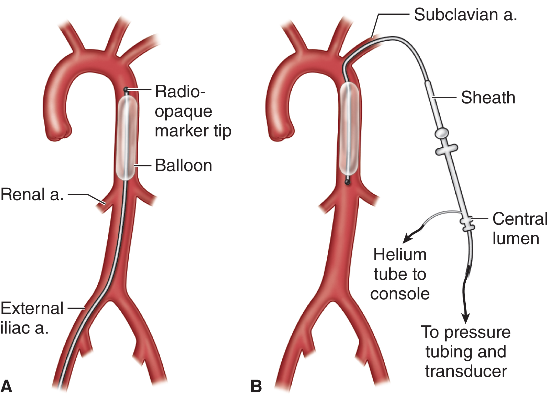 Intra Aortic Balloon Pump (IABP) Types BioRender Science, 47% OFF