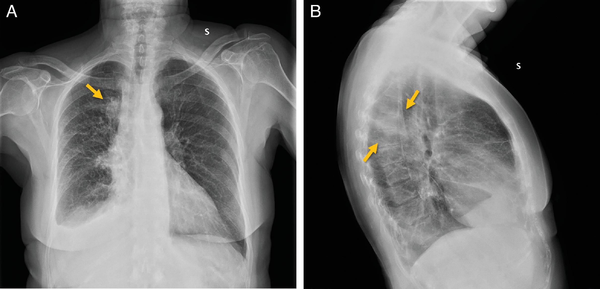 Malignant Pleural Effusion In Metastatic Pulmonary Adenocarcinoma ...