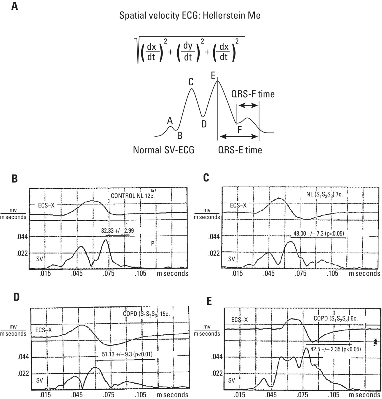 Ventricular Blocks | Thoracic Key