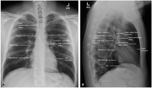 Chest Radiography | Thoracic Key