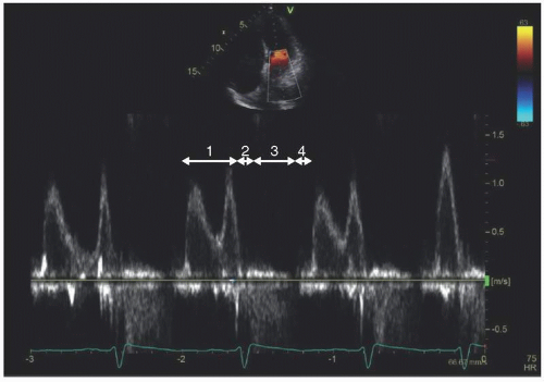 Hyperdynamic Left Ventricular Systolic Function