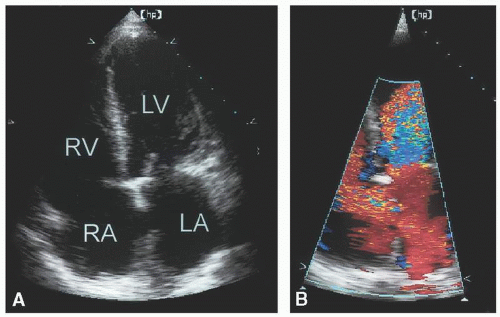 Intracardiac Shunts | Thoracic Key