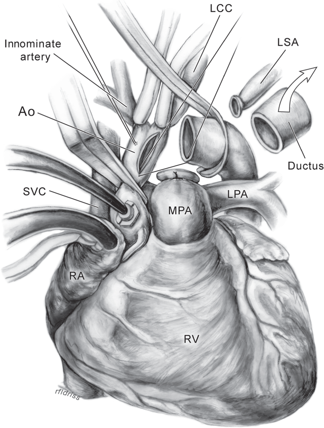 Interrupted Aortic Arch | Thoracic Key