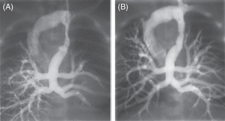 Total Anomalous Pulmonary Venous Connection | Thoracic Key