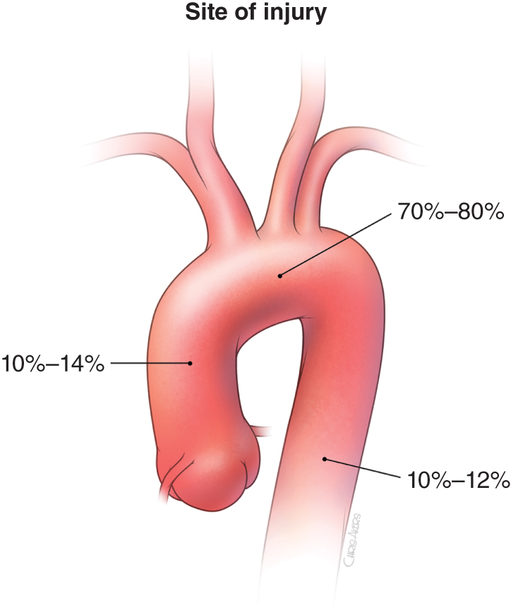 A diagram shows labeled percentages of injury locations along the thoracic aorta. The diagram shows the thoracic aorta with three labeled regions under the heading Site of injury. A label shows 70 percent to 80 percent points to the aortic isthmus. A label shows 10 percent to 14 percent points to the descending thoracic aorta just below the arch. A label shows 10 percent to 12 percent points to the ascending thoracic aorta.