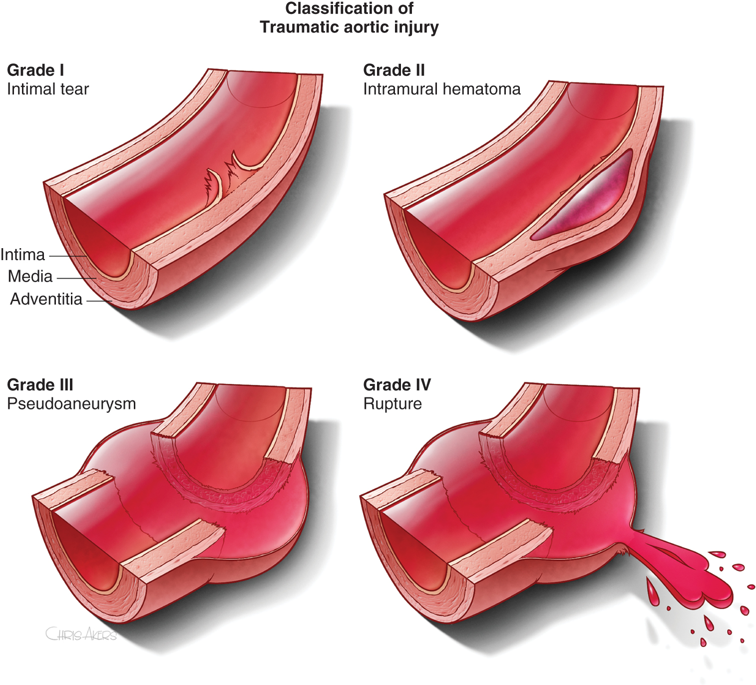 A diagram shows four graded forms of traumatic aortic injury from intimal tear to rupture. The diagram presents four labeled cross-sectional views of the thoracic aorta under the heading Classification of Traumatic Aortic Injury. Grade first shows an intimal tear with small surface disruptions of the inner layer. Grade second shows an intramural hematoma with a bulging collection within the aortic wall. Grade three shows a pseudoaneurysm with an outward bulge that extends beyond the normal aortic contour. Grade four shows rupture with a full-thickness disruption of the wall and extravasation of blood. Labels for Intima, Media, and Adventitia appear alongside the Grade first panel.