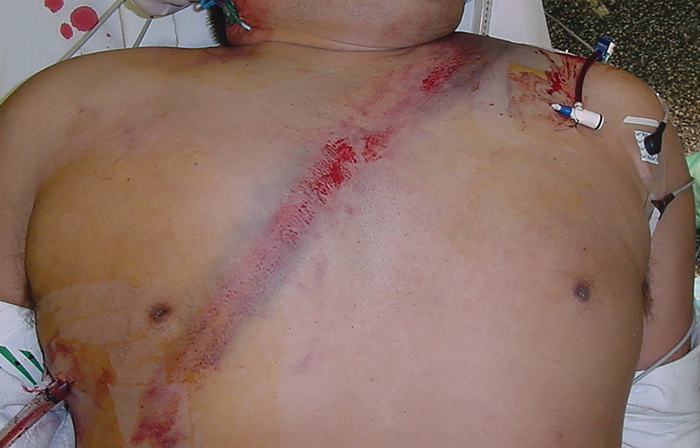 A clinical illustration shows a diagonal chest marking associated with blunt impact.