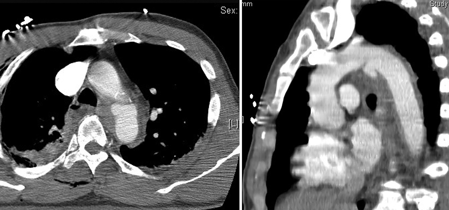 A pair of C T scans shows axial and sagittal views of the thoracic aorta. The pair of C T scans shows the thorax placed side by side. The left panel presents an axial view with the aortic arch and surrounding mediastinal structures shown as cross-sectional shapes of varying density. The right panel presents a sagittal view displaying the length of the thoracic aorta and adjacent soft tissue structures. Both panels show contrast-filled blood pools within the aorta and adjacent anatomic contours, with surrounding bone structures appearing as bright outer rings.