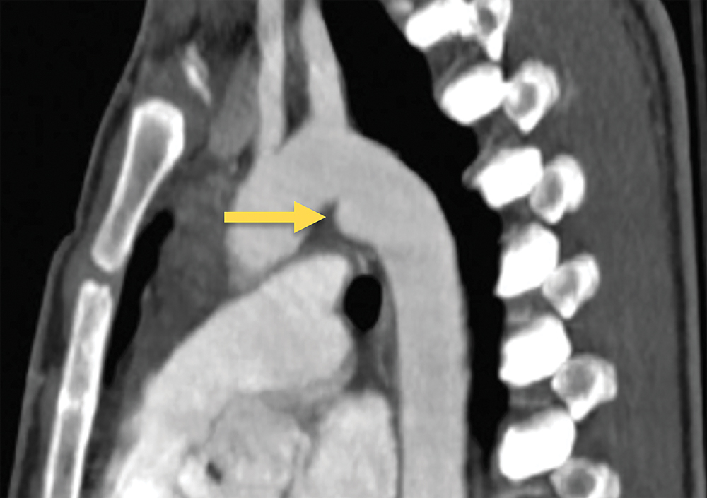 A sagittal C T scan shows a small focal outpouching along the aortic wall marked by an arrow. The sagittal C T scan shows the thoracic aorta with an arrow pointing to a smooth focal bulge along the inner curve of the aortic arch. Surrounding vertebral bodies and mediastinal structures are shown in cross-section. The aortic lumen is filled with contrast, and the arrow highlights a localised protrusion continuous with the aortic wall.