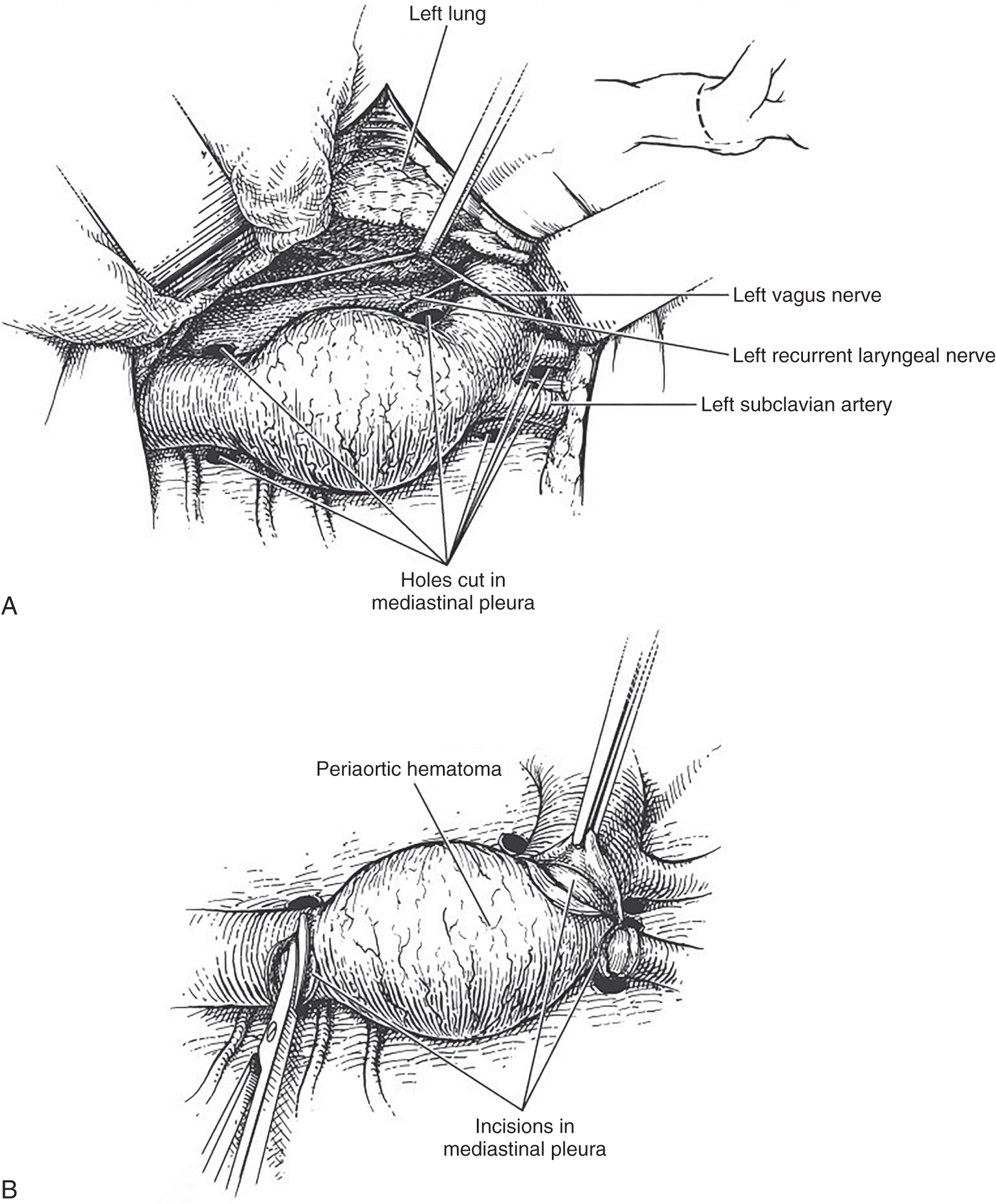 A surgical illustration depicts exposure and dissection of a traumatised descending thoracic aorta, followed by progressive exposure, clamping, and graft repair. The pair of panels illustrates presents labeled A and B depicting the surgical exposure of the descending thoracic aorta. Panel A shows the opened left thoracotomy with the left lung retracted superiorly. labeled structures include the left vagus nerve, the left recurrent laryngeal nerve, and the left subclavian artery. The aorta is enlarged by a subpleural hematoma, and several small openings labeled Holes cut in mediastinal pleura appear along the anterior surface. Panel B shows the initial stages of dissection with the aorta surrounded by a peri-aortic hematoma. Labels indicate Incisions in the mediastinal pleura along the arch proximal to the left subclavian artery and along the descending aorta. The set of panels illustrates presents labeled C, D, E, F, and G depicting sequential steps in the repair of the descending thoracic aorta. Panel C shows the aorta surrounded by mediastinal tissue with several Incisions in the mediastinal pleura labeled along the anterior surface. Panel D shows Aortic clamps repositioned above and below the exposed segment with intercostal arteries labeled along the posterior surface. Panel E shows the aortic tear being closed with a direct suture while the clamps remain in place above and below the repair site. Panel F shows a woven graft positioned over the opened aorta with sutures placed along the proximal end. Panel G shows the graft fully attached to the proximal and distal aorta with continuous sutures securing both ends.