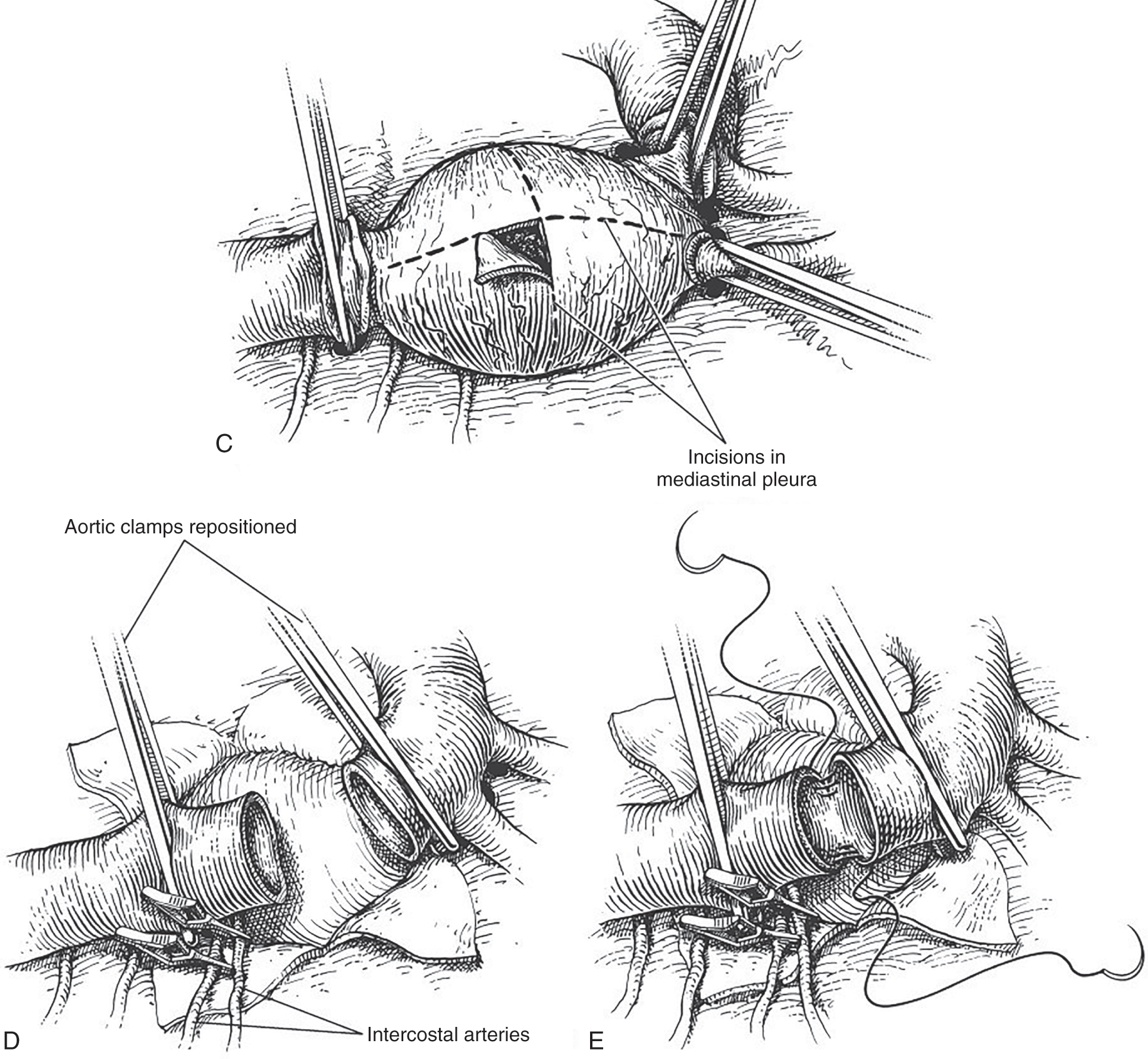 A surgical illustration depicts exposure and dissection of a traumatised descending thoracic aorta, followed by progressive exposure, clamping, and graft repair. The pair of panels illustrates presents labeled A and B depicting the surgical exposure of the descending thoracic aorta. Panel A shows the opened left thoracotomy with the left lung retracted superiorly. labeled structures include the left vagus nerve, the left recurrent laryngeal nerve, and the left subclavian artery. The aorta is enlarged by a subpleural hematoma, and several small openings labeled Holes cut in mediastinal pleura appear along the anterior surface. Panel B shows the initial stages of dissection with the aorta surrounded by a peri-aortic hematoma. Labels indicate Incisions in the mediastinal pleura along the arch proximal to the left subclavian artery and along the descending aorta. The set of panels illustrates presents labeled C, D, E, F, and G depicting sequential steps in the repair of the descending thoracic aorta. Panel C shows the aorta surrounded by mediastinal tissue with several Incisions in the mediastinal pleura labeled along the anterior surface. Panel D shows Aortic clamps repositioned above and below the exposed segment with intercostal arteries labeled along the posterior surface. Panel E shows the aortic tear being closed with a direct suture while the clamps remain in place above and below the repair site. Panel F shows a woven graft positioned over the opened aorta with sutures placed along the proximal end. Panel G shows the graft fully attached to the proximal and distal aorta with continuous sutures securing both ends.
